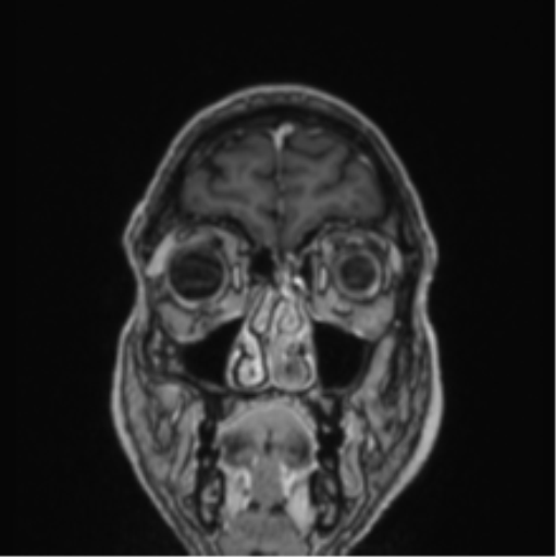File:Colloid cyst of the third ventricle (Radiopaedia 86571-102662 Coronal T1 C+ 80).png