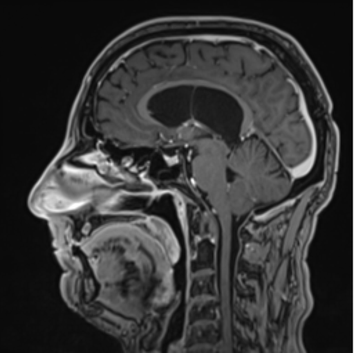 File:Colloid cyst of the third ventricle (Radiopaedia 86571-102662 Sagittal T1 C+ 41).png