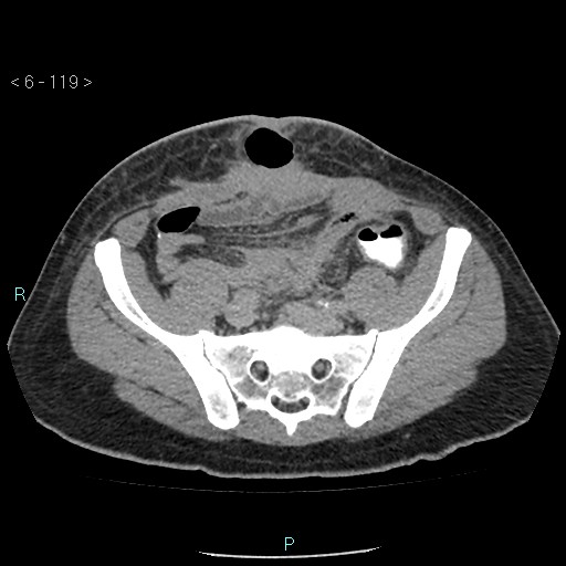 File:Colo-cutaneous fistula (Radiopaedia 40531-43129 A 49).jpg