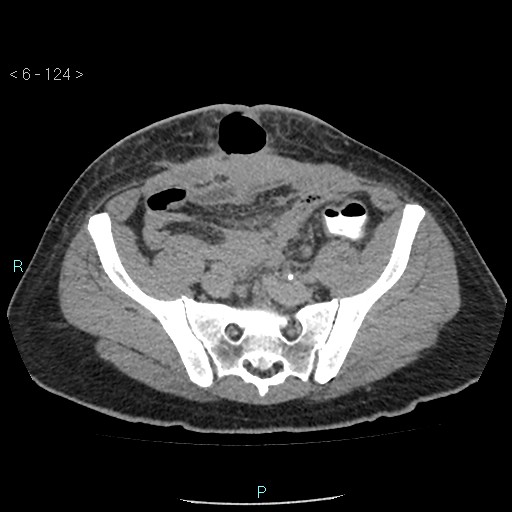 File:Colo-cutaneous fistula (Radiopaedia 40531-43129 A 51).jpg