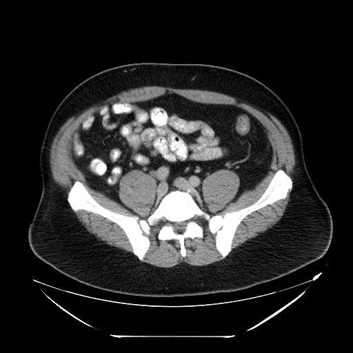 Colocolic intussusception due to lipoma (Radiopaedia 73712-84508 A 82).jpg
