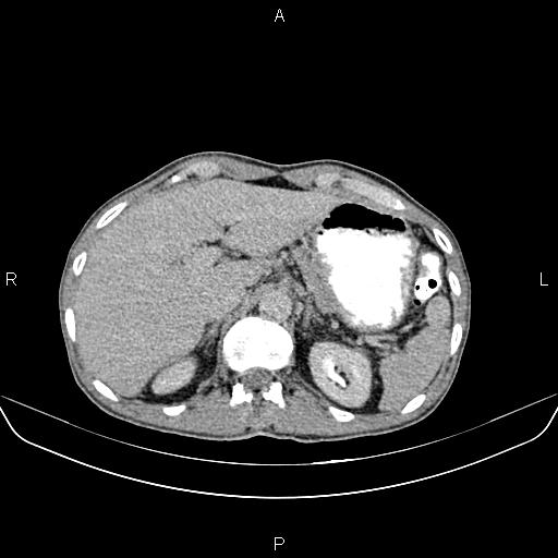 File:Colon adenocarcinoma - hepatic flexure (Radiopaedia 85635-101395 Axial C+ delayed 21).jpg