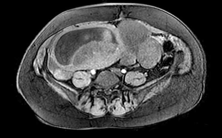 Colon adenocarcinoma with Krukenberg tumors, advanced pregnancy (Radiopaedia 67279-76645 A 32).jpg