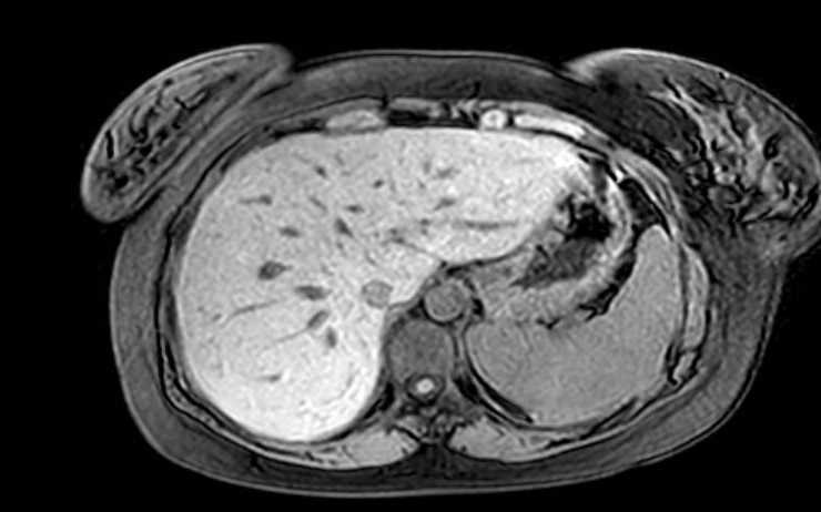 Colon adenocarcinoma with Krukenberg tumors, advanced pregnancy (Radiopaedia 67279-76645 A 69).jpg