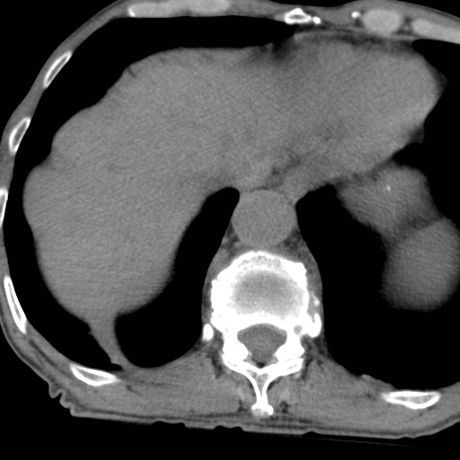 Colon cancer with calcified liver metastasis (Radiopaedia 74423-85309 Axial non-contrast 15).jpg