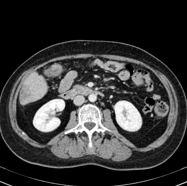 Colon carcinoma with hepatic metastases (Radiopaedia 29477-29961 A 52).jpg