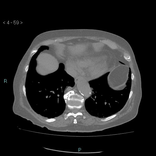 Colonic lipomas (Radiopaedia 49137-54244 Axial bone window 27).jpg