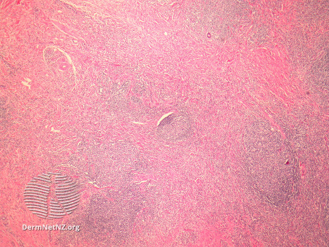 File:Figure 1 (DermNet NZ pathology-e-angiolymphoid-hyperplasia-figure-1).jpg