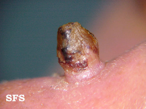 File:Keratoacanthoma (Dermatology Atlas 2).jpg