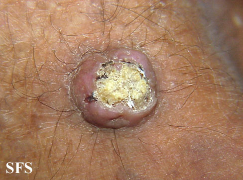 File:Keratoacanthoma (Dermatology Atlas 25).jpg