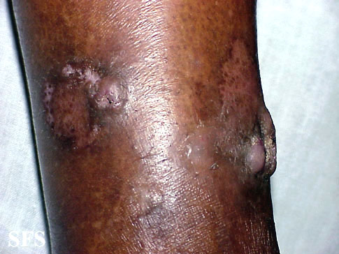 File:Keratoacanthoma (Dermatology Atlas 29).jpg