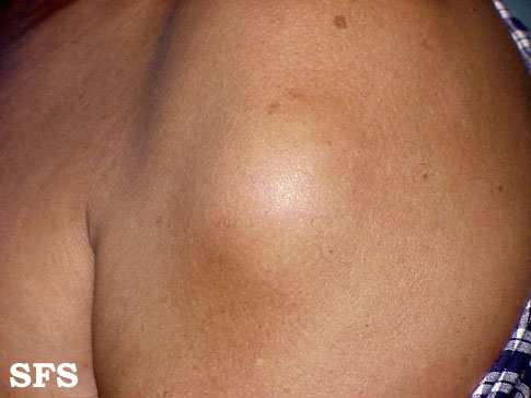 File:Lipoma (Dermatology Atlas 2).jpg