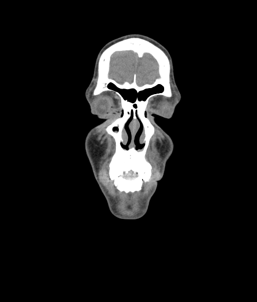 Nasal pyogenic granuloma (lobular capillary hemangioma) (Radiopaedia 85536-101244 Coronal non-contrast 54).jpg