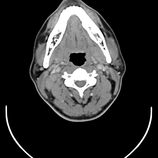 File:Nasopharyngeal carcinoma with pterygopalatine fossa involvement (Radiopaedia 33102-34132 A 27).png