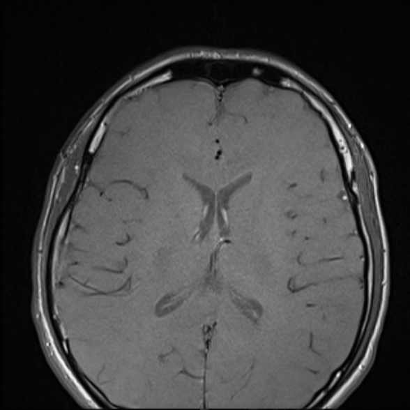 Nasopharyngeal carcinoma with skull base invasion (Radiopaedia 53415-59485 Axial T1 5).jpg