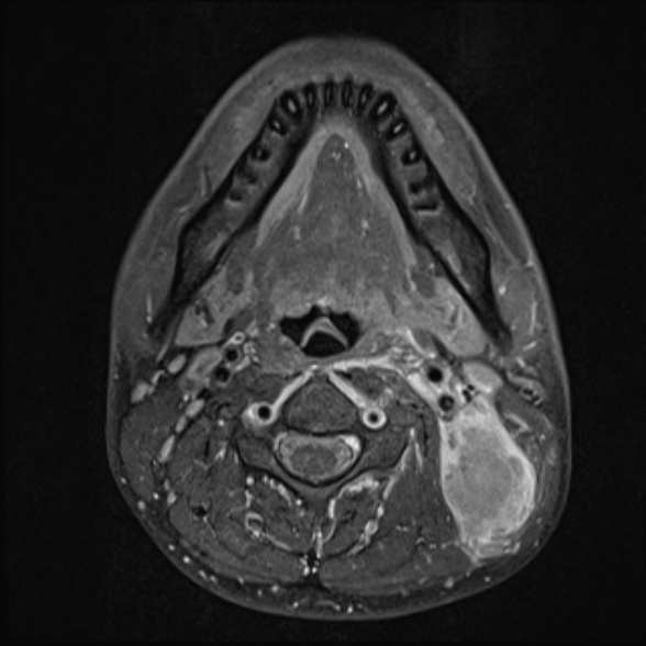 Nasopharyngeal carcinoma with skull base invasion (Radiopaedia 53415-59485 Axial T1 C+ fat sat 45).jpg