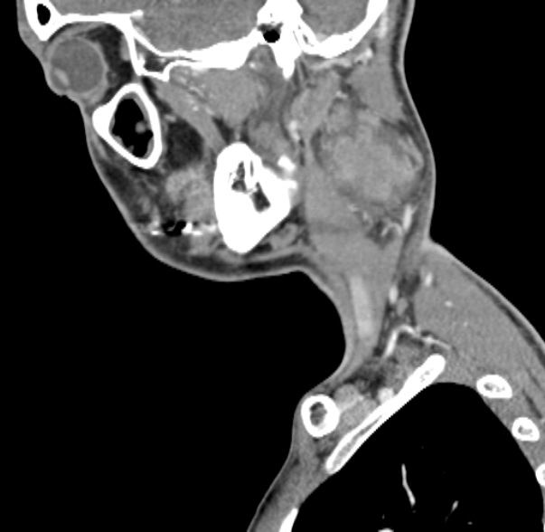 File:Nasopharyngeal carcinoma with skull base invasion (Radiopaedia 53415-59705 C 57).jpg