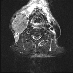 File:Nasopharyngeal carcinoma with skull base invasion (Radiopaedia 59258-66600 Axial T2 fat sat 6).jpg