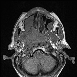 Nasopharyngeal carcinoma with skull base invasion (Radiopaedia 59258-66600 B 21).jpg