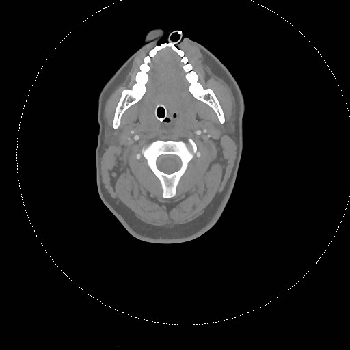 Neck CT angiogram (intraosseous vascular access) (Radiopaedia 55481-61945 B 217).jpg