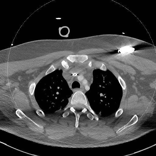 Neck CT angiogram (intraosseous vascular access) (Radiopaedia 55481-61945 B 64).jpg