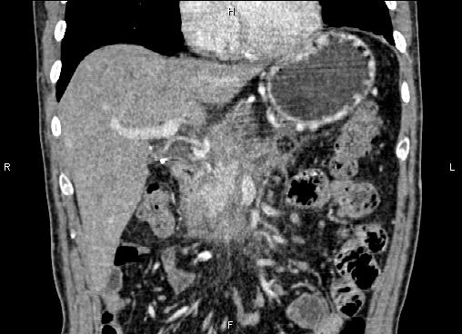 Necrotizing pancreatitis (Radiopaedia 87796-104248 F 24).jpg
