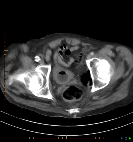 Necrotzing fasciitis due to a perforated adenocarcinoma of the splenic flexure (Radiopaedia 46930-51455 A 59).jpg