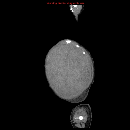 File:Neonatal neuroblastoma (Radiopaedia 9564-10223 C 15).jpg