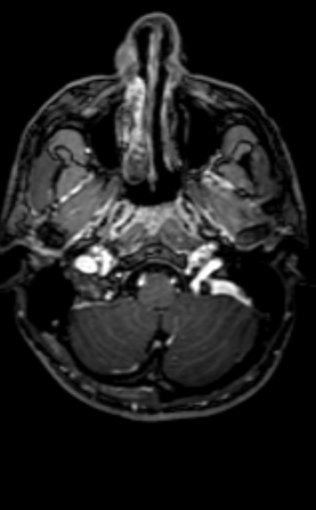 Neuro-Behçet disease (Radiopaedia 90112-107294 Axial T1 C+ 187).jpg