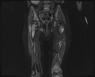 File:Neuroblastoma with bone metastases (Radiopaedia 67080-76414 Coronal STIR 14).jpg