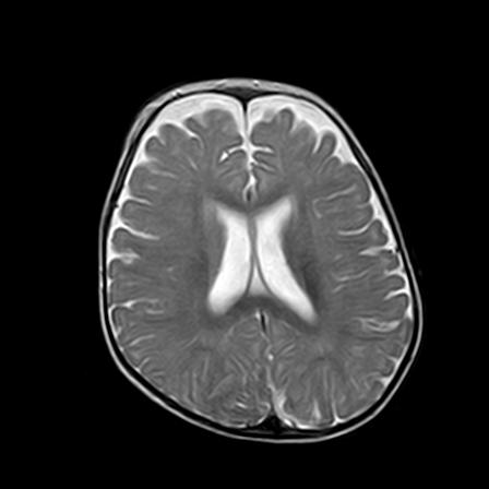 File:Neurofibromatosis type 1 (Radiopaedia 30089-30671 Axial T2 15).jpg
