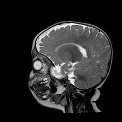 File:Neurofibromatosis type 1 (Radiopaedia 30089-30671 Sagittal T2 13).jpg