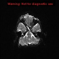 File:Neurofibromatosis type 1 with optic nerve glioma (Radiopaedia 16288-15965 Axial DWI 18).jpg