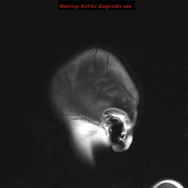 File:Neurofibromatosis type 1 with optic nerve glioma (Radiopaedia 16288-15965 Sagittal T1 1).jpg