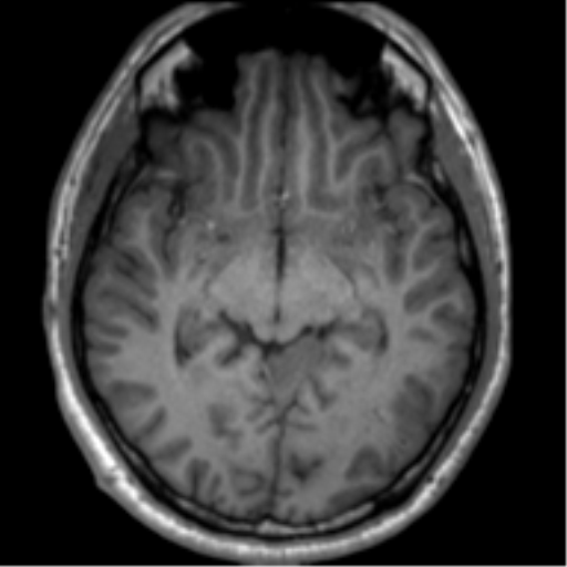 File:Neurofibromatosis type 2 (Radiopaedia 44936-48838 Axial T1 62).png