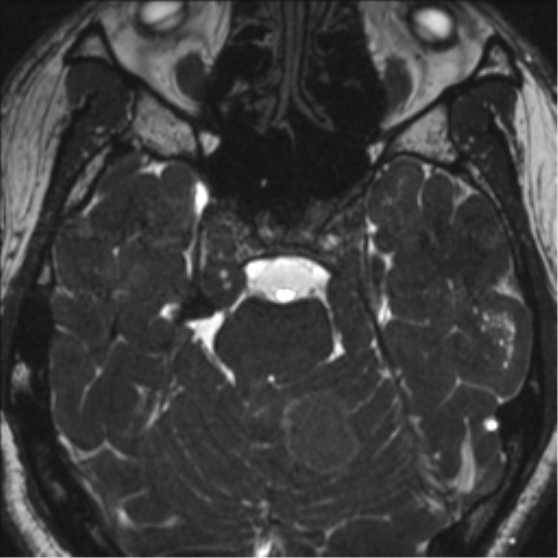 Neurofibromatosis type 2 (Radiopaedia 44936-48838 E 42).png