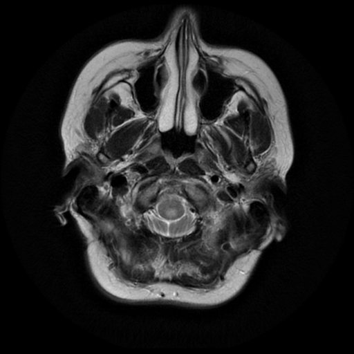 File:Neurofibromatosis type 2 (Radiopaedia 45229-49247 Axial T2 3).png