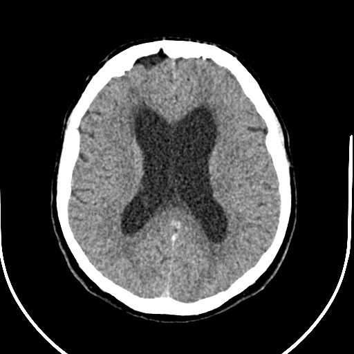 Neurofibromatosis type 2 (Radiopaedia 79097-92047 Axial non-contrast 36).jpg