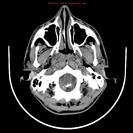 File:Neurofibromatosis type 2 (Radiopaedia 8953-9732 Axial non-contrast 1).jpg