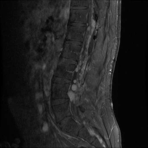 File:Neurofibromatosis type 2 (spinal manifestations) (Radiopaedia 53943-60070 K 7).png
