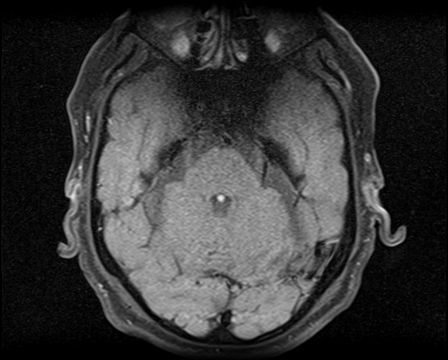 File:Non-Hodgkin lymphoma - parotid gland (Radiopaedia 71531-81890 T1 fat sat 24).jpg