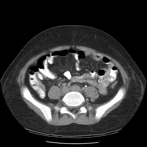File:Non-Hodgkin lymphoma involving pelvis (Radiopaedia 21281-21197 B 43).jpg