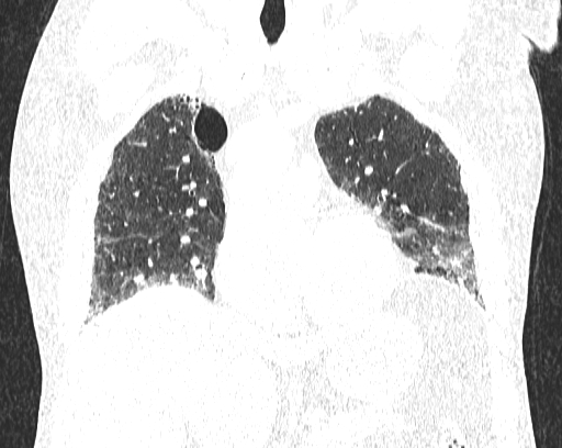 Non-specific interstitial pneumonia (NSIP) (Radiopaedia 68599-78228 Coronal lung window 36).jpg