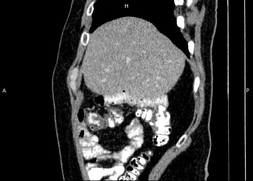 Non-syndromic pancreatic endocrine tumor (Radiopaedia 86958-103178 E 14).jpg