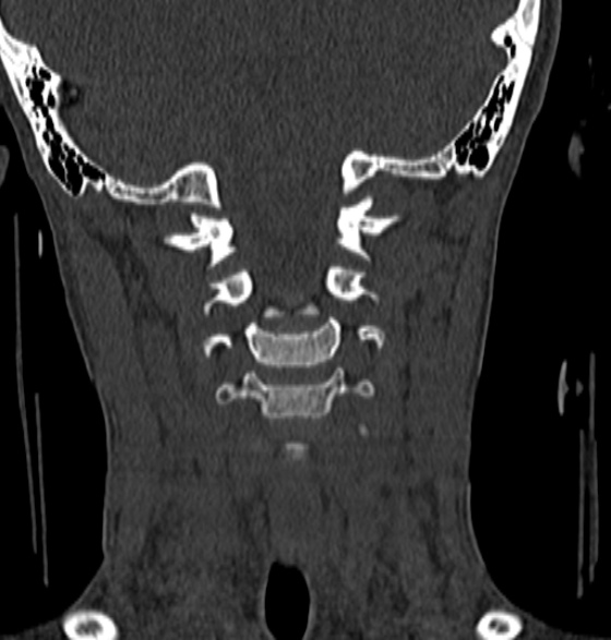 File:Normal CT cervical spine - 12-year-old (Radiopaedia 55352-61775 Coronal bone window 88).jpg