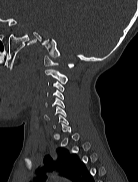 File:Normal CT cervical spine - pediatric (Radiopaedia 52549-58462 Sagittal bone window 164).jpg