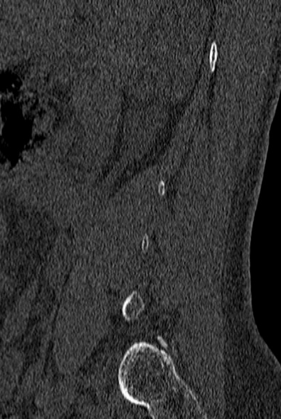 File:Normal CT lumbar spine (Radiopaedia 53981-60118 Sagittal bone window 8).jpg