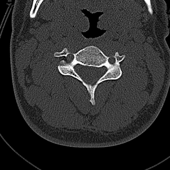 File:Normal CT of the cervical spine (Radiopaedia 53322-59305 Axial bone window 112).jpg