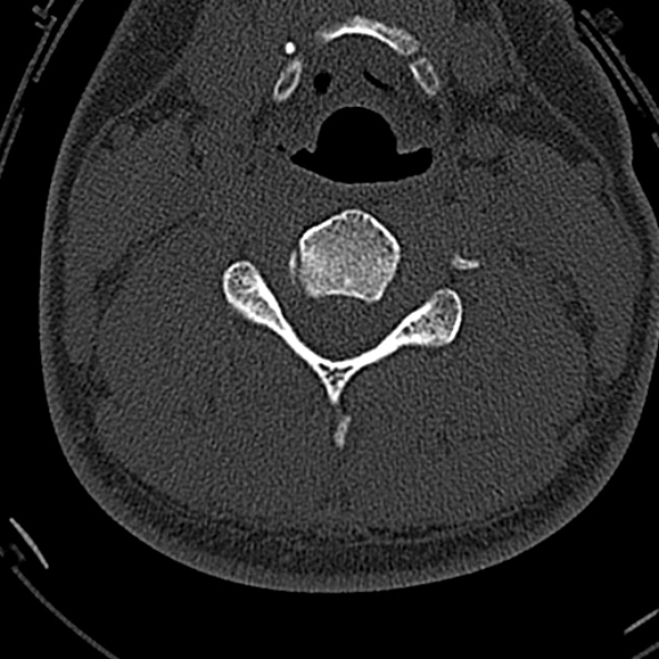 Normal CT of the cervical spine (Radiopaedia 53322-59305 Axial bone window 143).jpg