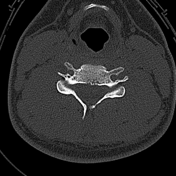 Normal CT of the cervical spine (Radiopaedia 53322-59305 Axial bone window 157).jpg